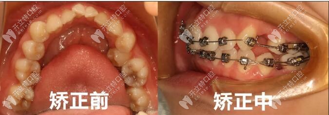 陳庫正畸醫(yī)生牙齒矯正案例一