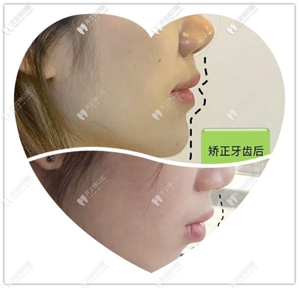 重慶美奧口腔被重慶杜鵬醫(yī)生做的Invisalign矯正“齙牙+凸嘴”案例圈粉啦