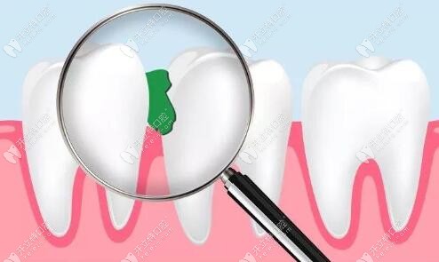 塞牙不治的危害