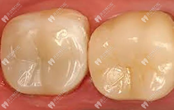 補(bǔ)牙后的效果圖 補(bǔ)牙后的效果圖