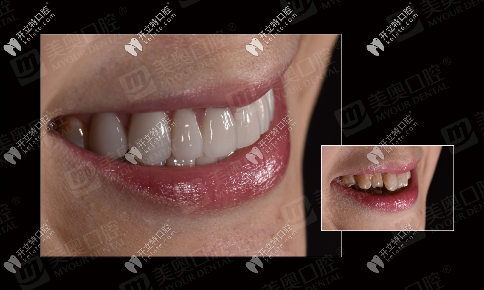 牛!刷爆朋友圈的3D超薄瓷貼面修復(fù)病例，竟是出自美奧口腔