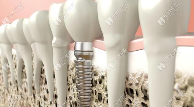 動(dòng)真格：這即刻負(fù)重種植技術(shù)，真能實(shí)現(xiàn)當(dāng)天種牙當(dāng)天吃！