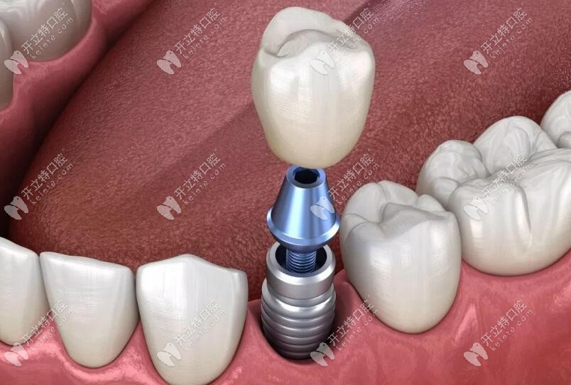 即刻種植、即刻負(fù)重技術(shù)優(yōu)勢