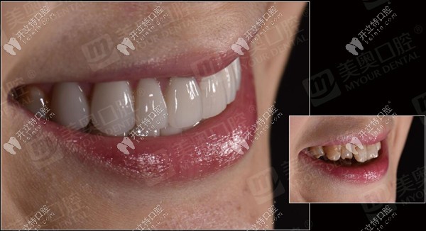 3D超薄瓷貼面修復病例