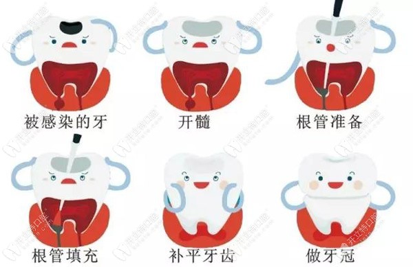 終于有人把去髓術(shù)和根管治療失敗的原因講明白了