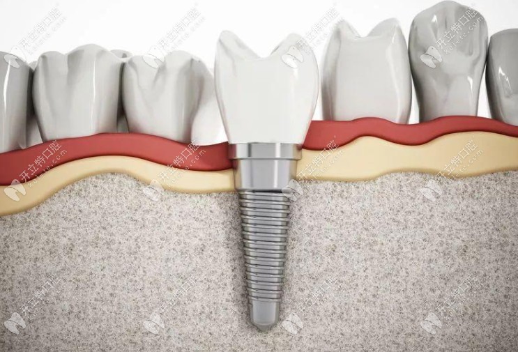 柏德口腔種植牙牙體模型