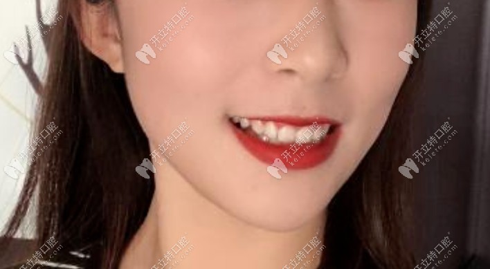 摘了牙套后牙齒整體效果