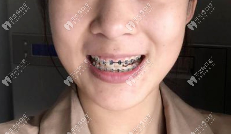 矯正剛帶上牙套一周的時(shí)間