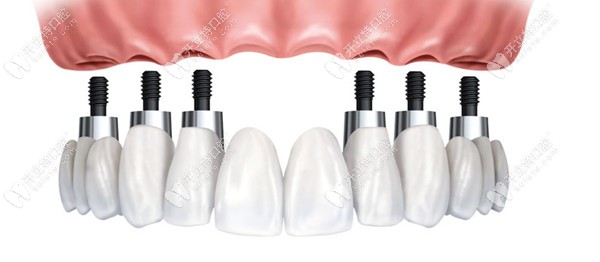 傳統(tǒng)的種植牙技術(shù)時(shí)間比較長