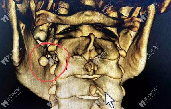 罕見的涎石癥也會引起口腔下頜腫脹、疼痛