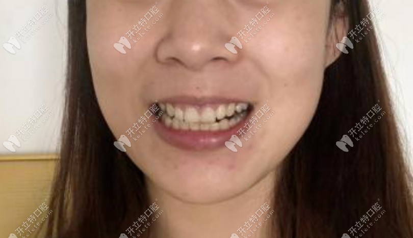 咬合不正導(dǎo)致嘴歪嚇得我麻溜去做了奧美科金屬托槽矯正