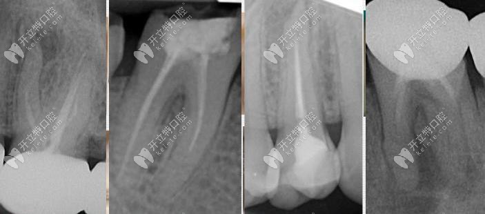 上課啦：你知道藥物中的EDTA在根管治療中起什么作用嗎？