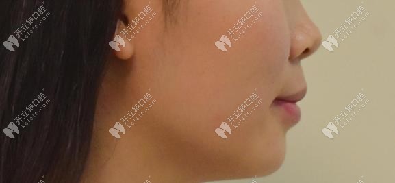 完成矯正后的側(cè)面變化