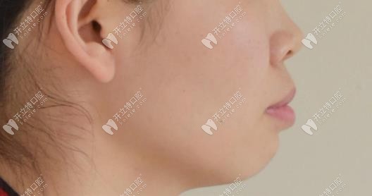 矯正前我的側(cè)面情況