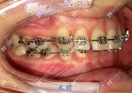 剛戴上牙套牙齒的樣子