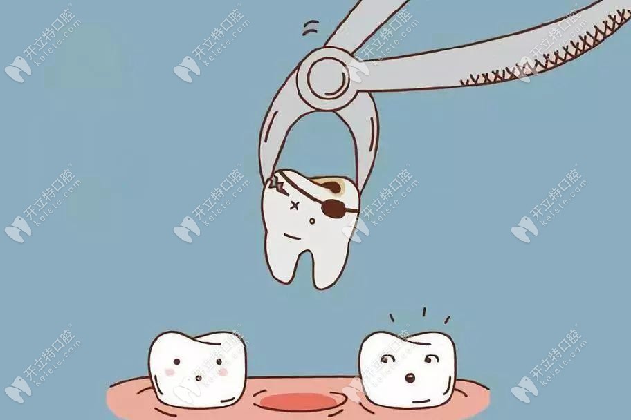 矯正拔除了一顆牙齒