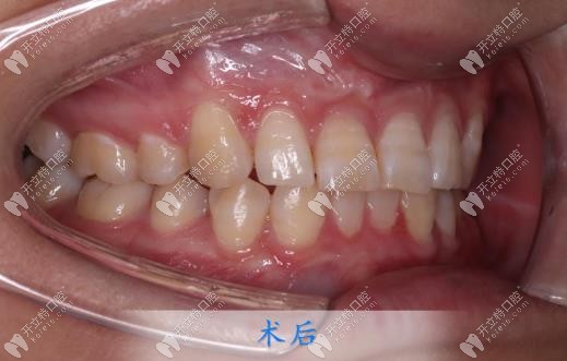 取下牙套后牙齒變整齊啦