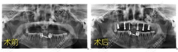 案例|半口6顆植體做即刻種植牙只要2小時(shí),且當(dāng)天戴冠吃東西