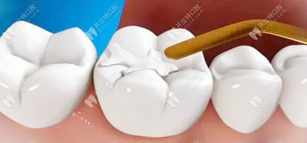 又問美國進口3M樹脂補牙的價格？z350與250多少錢都在這了！