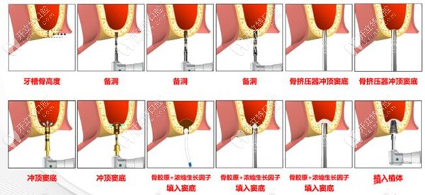 骨膠原和濃縮生長(zhǎng)因子