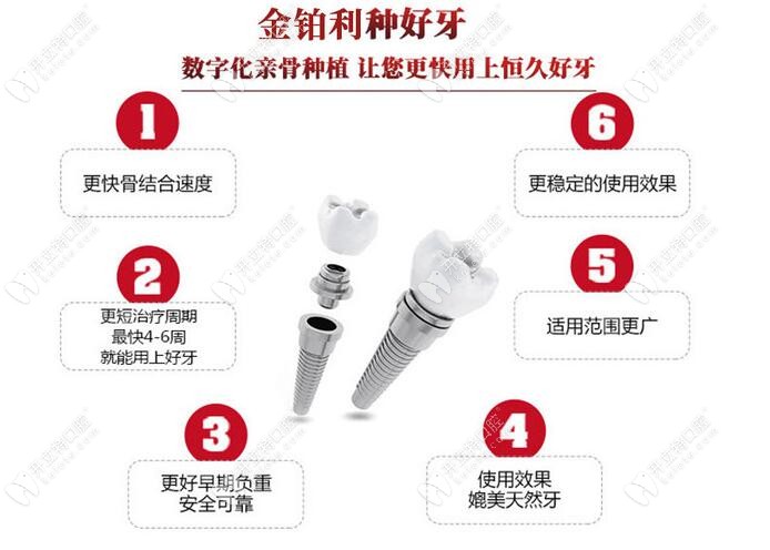 嘉興金鉑利種植牙的優(yōu)勢(shì)