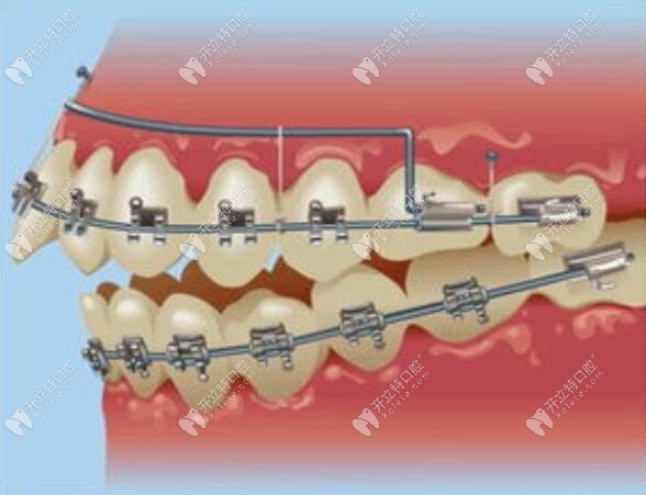 美維集團(tuán)的維樂(lè)口腔做美國(guó)damon自鎖托槽矯正好的真相是......