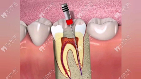 漲知識(shí)啦,原來(lái)根管超聲蕩洗的流程和作用是這樣滴