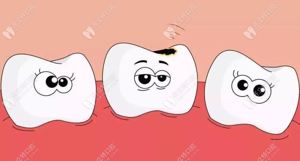 后面大牙齲壞補(bǔ)洞