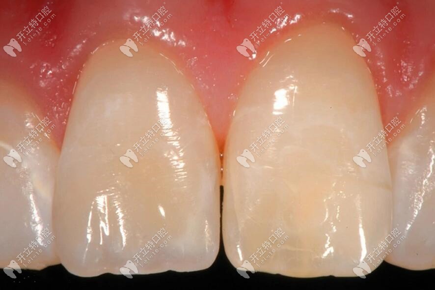 美塑補(bǔ)牙后效果圖