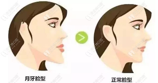 矯正失敗還是成功對(duì)比明顯