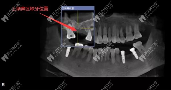 用3D數(shù)字化導(dǎo)板技術(shù)做上頜竇區(qū)的精準(zhǔn)種植牙案例
