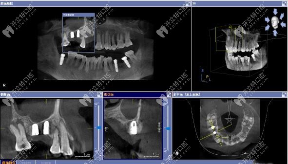 3D數(shù)字化導板上頜竇區(qū)種植案例