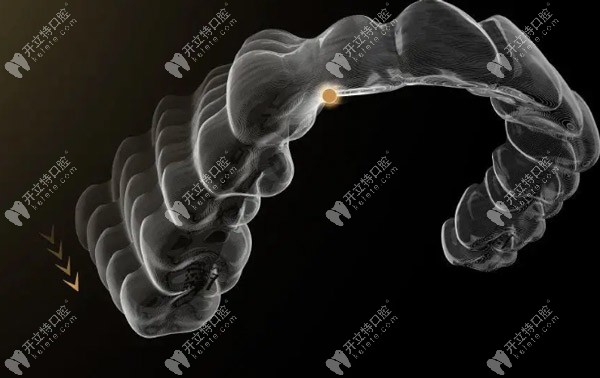 何為angelalign pro7+3雙膜交替模式