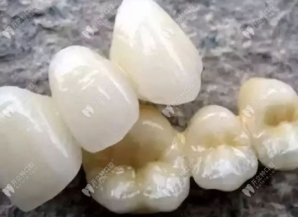 進口全瓷牙冠系列