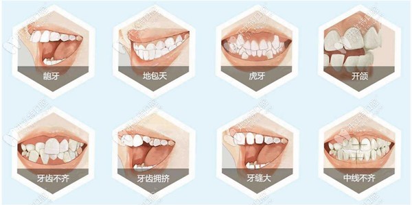 精誠(chéng)口腔院內(nèi)可矯正的病例
