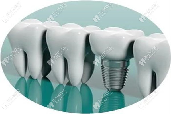 廣州圣貝種植牙