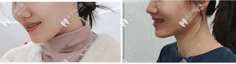 二次矯正：我決定在德益口腔做國產金屬托槽正畸經歷！