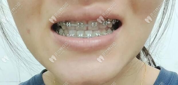 中線不齊，下牙排列不齊，以上問題下月調整