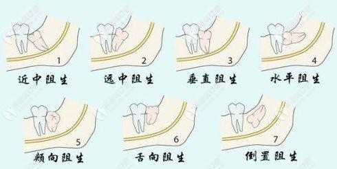 智齒難度不同價格也不同哦