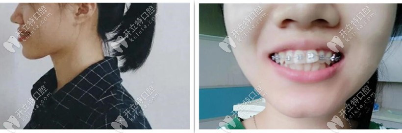 牙套兩個月側臉，嘴還是突