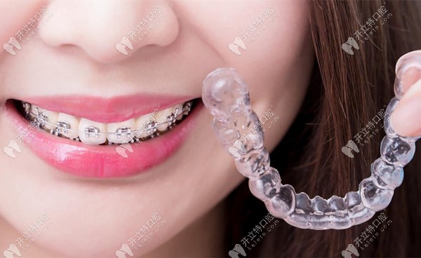 金屬矯正器和隱形矯正器的佩戴效果圖