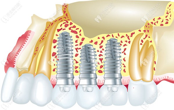 不同型號(hào)種植體在骨內(nèi)的<span style=
