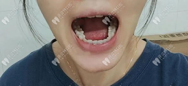 半年的時候，下排磨牙有些內傾