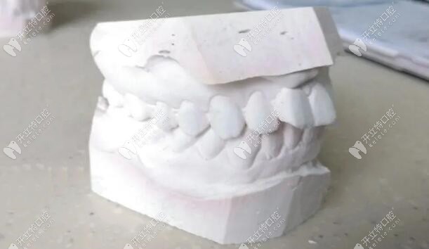 門牙有點凸嘴，牙齒不齊