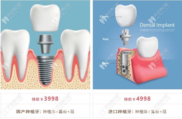 雁塔兒童全口涂氟9.9+ 窩溝封閉四顆118,價(jià)格優(yōu)惠到超乎想象