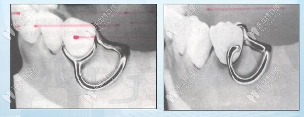 變異RPI卡環(huán)組