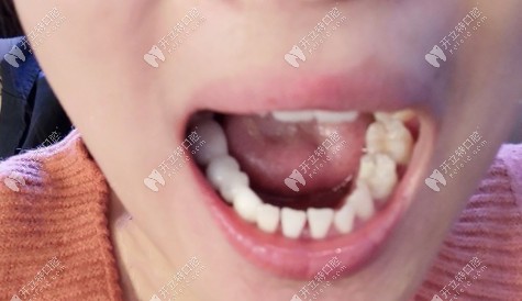 剛戴上臨時牙套