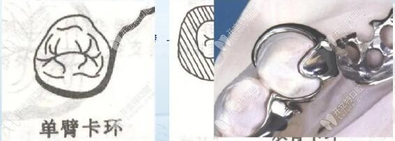 按卡環(huán)臂數(shù)目