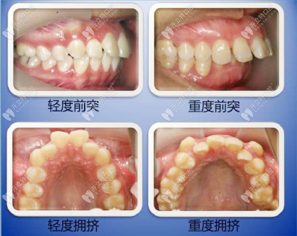 什么情況下需要拔牙才能矯正牙齒？