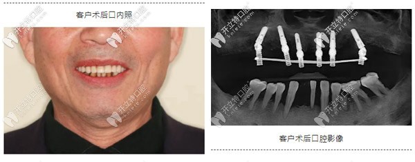 典型重度牙周炎種植案例:如何實(shí)現(xiàn)即刻種植與即刻修復(fù)？